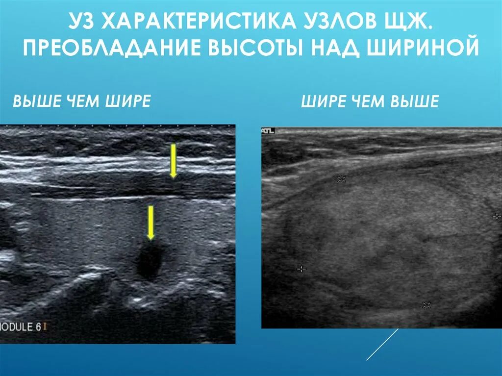 Узел в щитовидной железе на УЗИ. Узел щитовидной выше чем шире. Щитовидная железа узи лимфоузлы