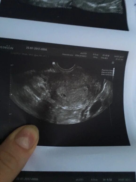 Узи 6 месяцев. Снимок УЗИ беременности 1-2 недели. Снимок УЗИ на 2 неделе беременности.