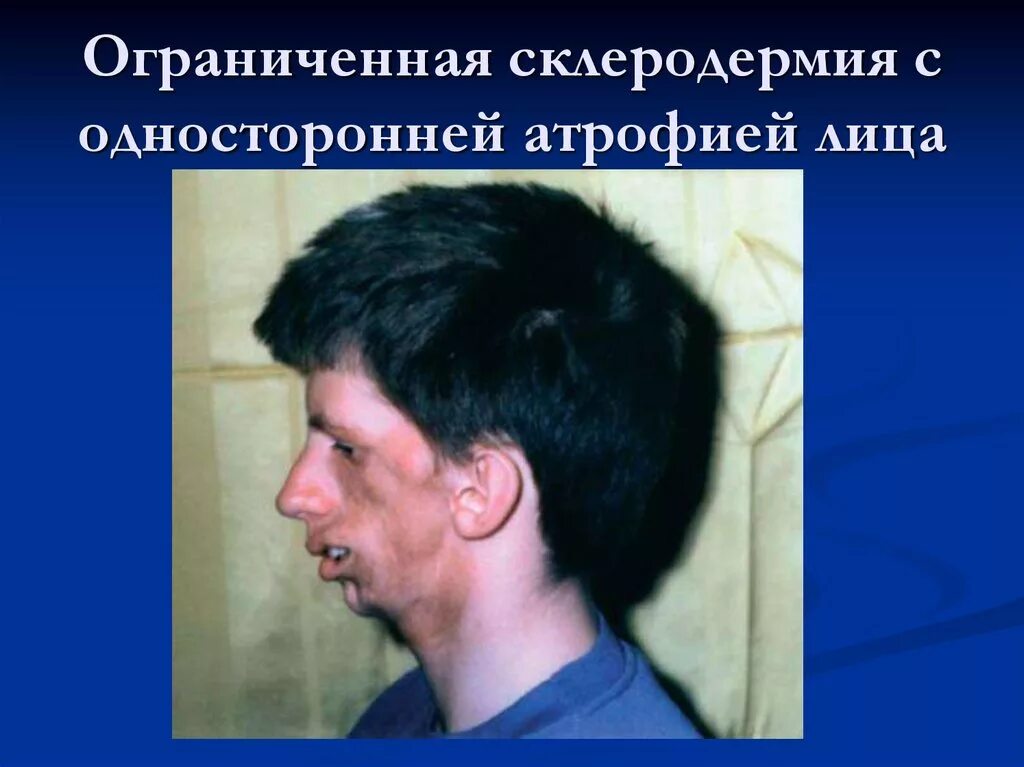 Диффузную системную склеродермию