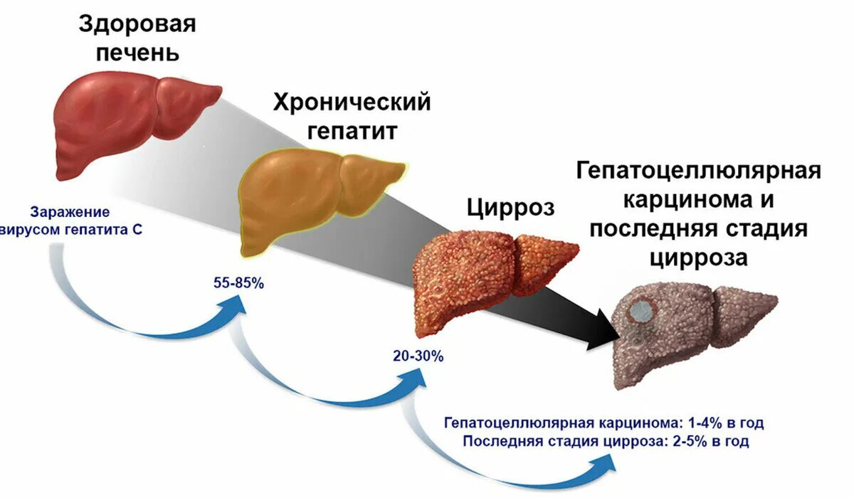 Долго ли живут с циррозом печени. Долго ли живут с циррозом печени