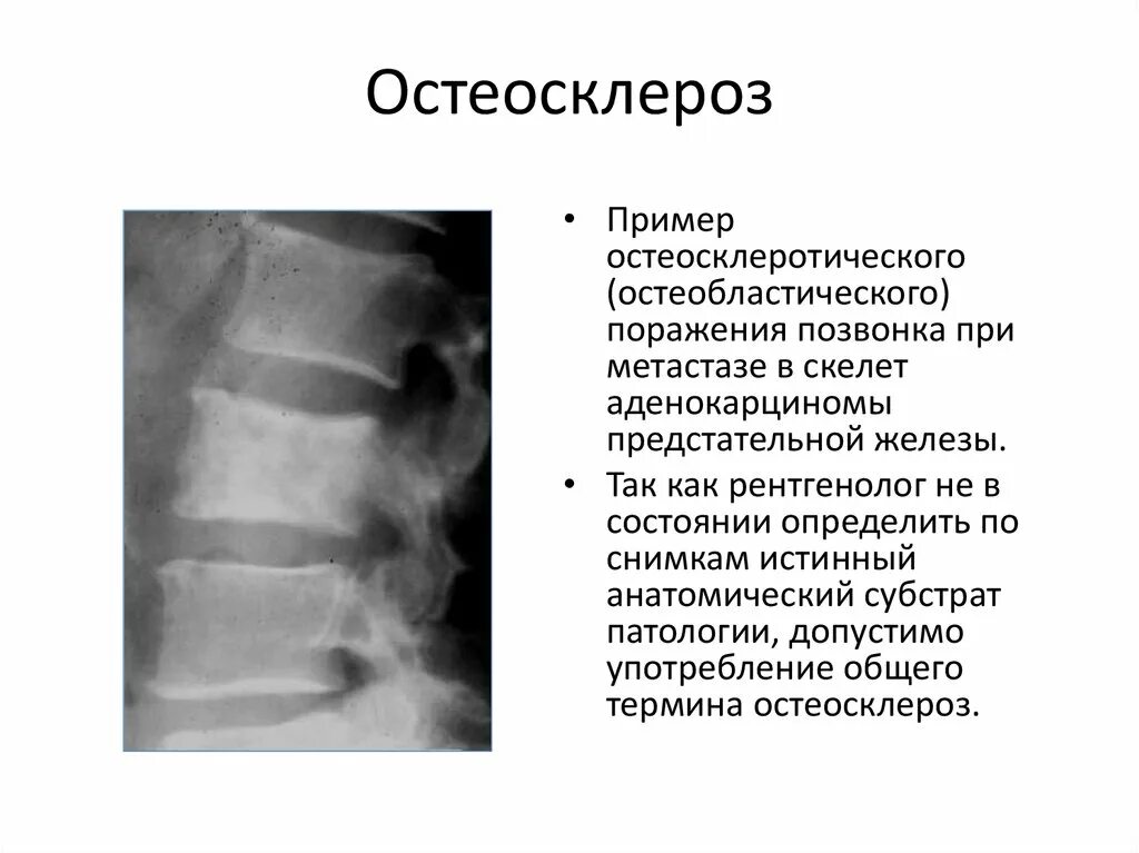 Остеосклероз грудного отдела. Остеосклероз грудного отдела