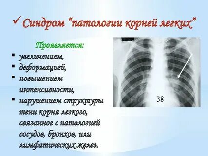 Легко корень