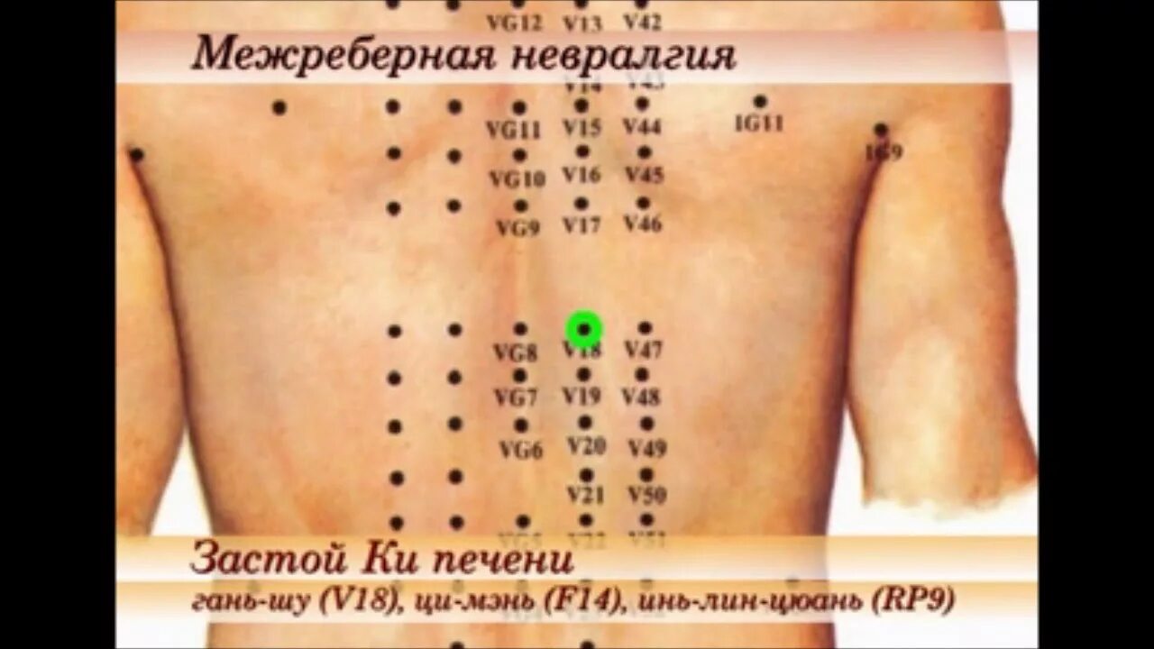 Можно ли при межреберной невралгии делать массаж. Точки при межреберной невралгии. точки массажа при межреберной невралгии. точечный массаж при межреберной невралгии точки. межреберная невралгия точки.