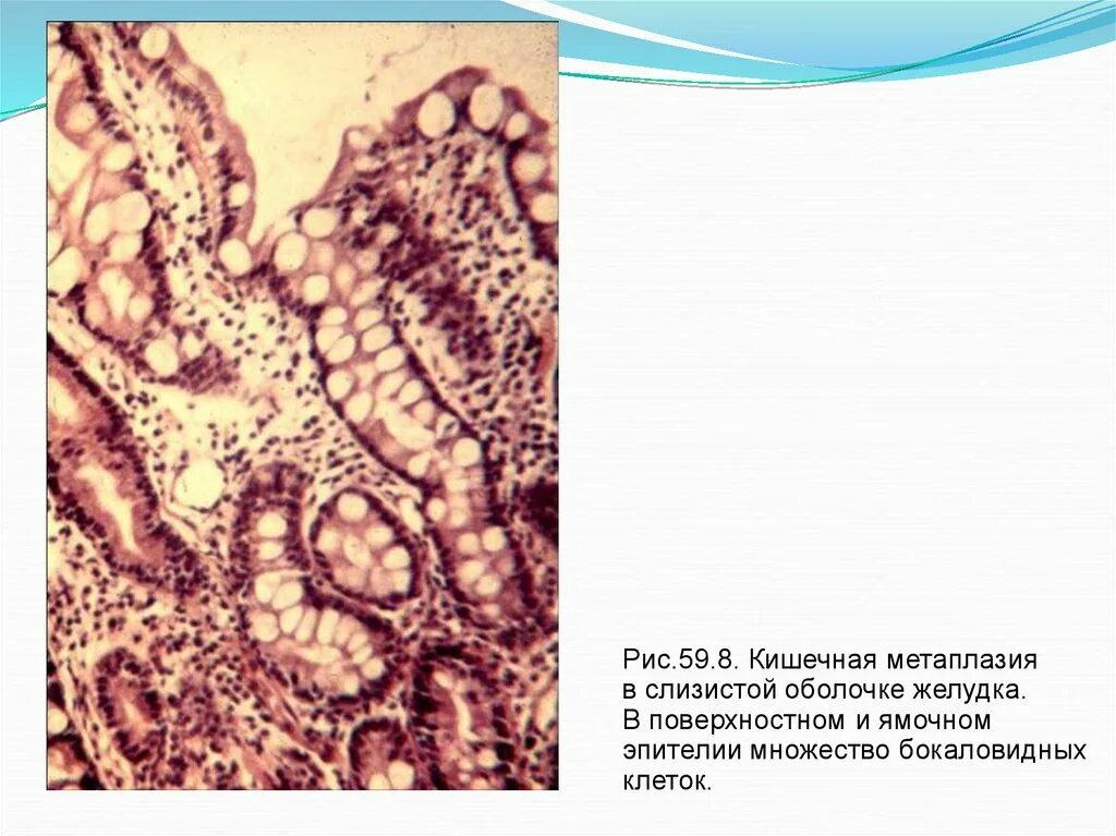Метаплазия желудка отзывы. Метаплазия слизистой оболочки желудка. Метаплазия поверхностного эпителия. Кишечная метаплазия желудка гистология. Кишечная метаплазия эпителия желудка гистология.
