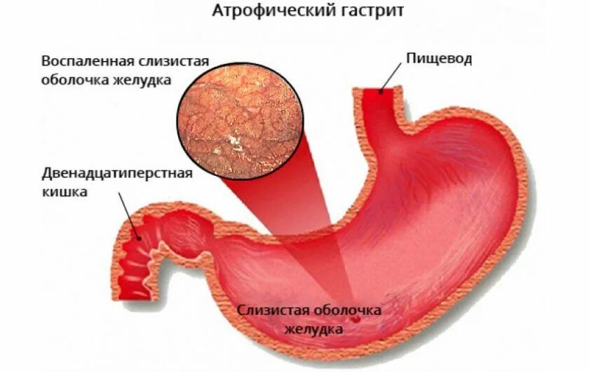 Признаки атрофией слизистой оболочки. Эритематозный антральный антральный гастрит. атрофический гастрит c1. атрофия слизистой антрального отдела желудка тип с-1. антральный и фундальный гастрит.