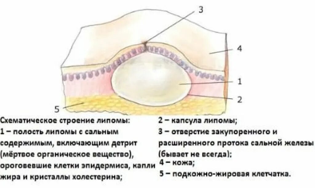 Совсем содержимым. Жировик подкожный строение. Липома жировик коленного сустава. Подкожно-жировая клетчатка липома.