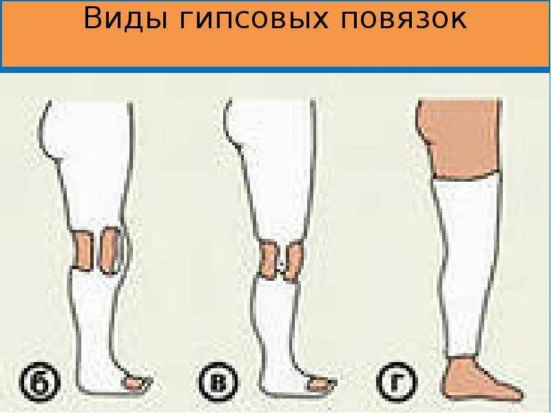 Трещина накладывают гипс. Перелом лодыжки лонгета. Гипсовая повязка лонгета. Перелом лодыжки гипсовая лангетка. Гипсовая повязка на коленный сустав.