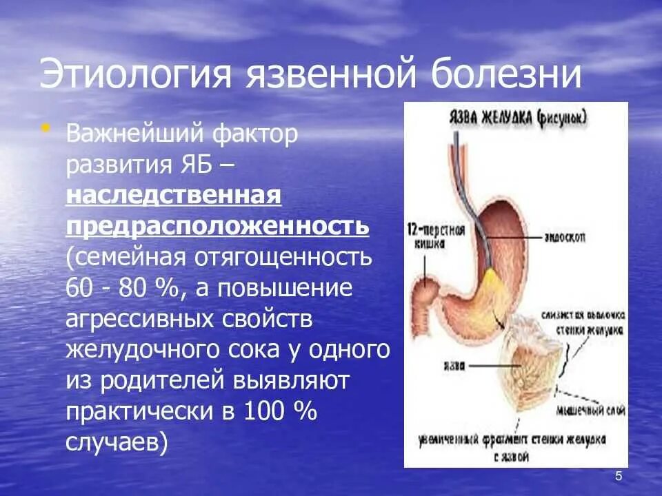 Язва желудка и 12 перстной кишки. Язвенная болезнь болезнь желудка и 12 перстной кишки. Язв.болезнь желудка и 12-перстной кишки этиология. Болезнь желудка и 12 перстной кишки. Соки при язве двенадцатиперстной