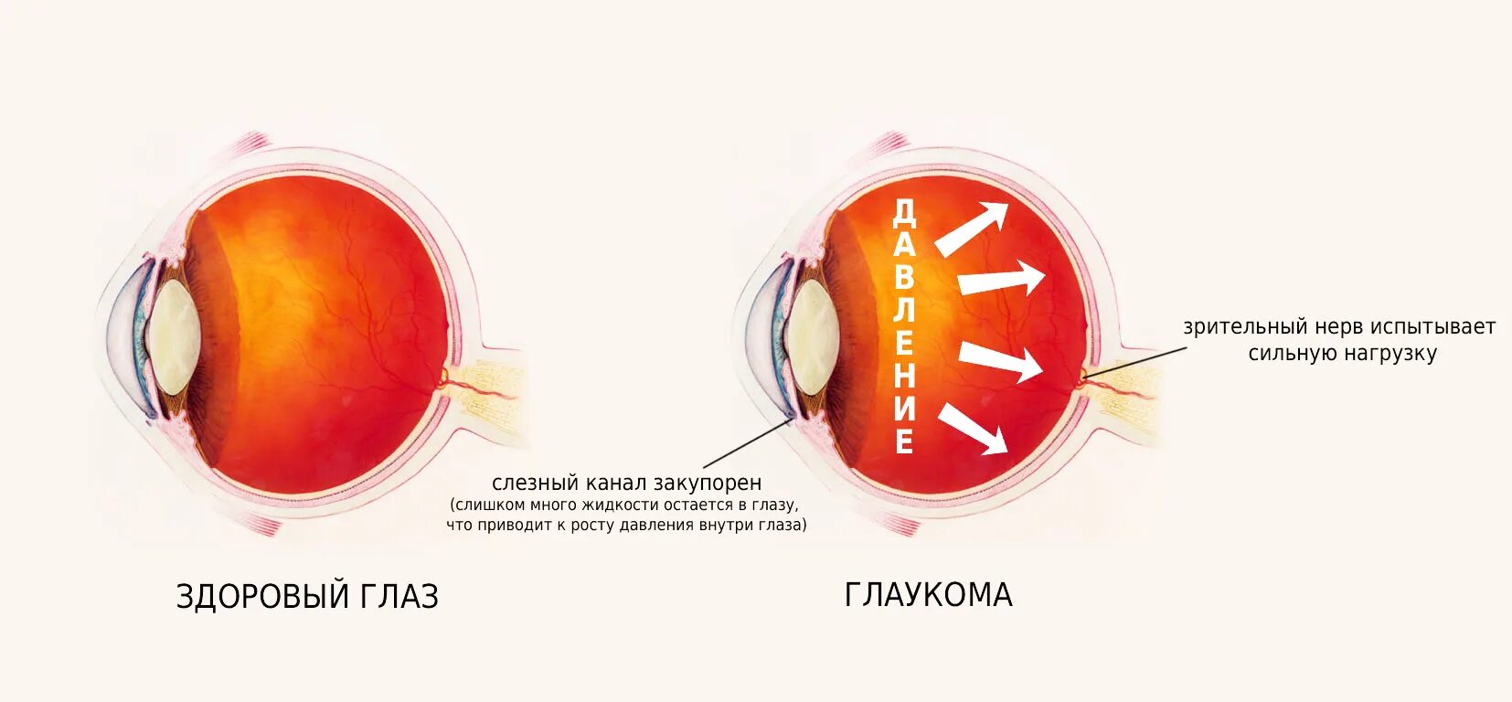 Глаза давление сильное. Патологии зрительного нерва глаукома. Глаукома схема глаза.