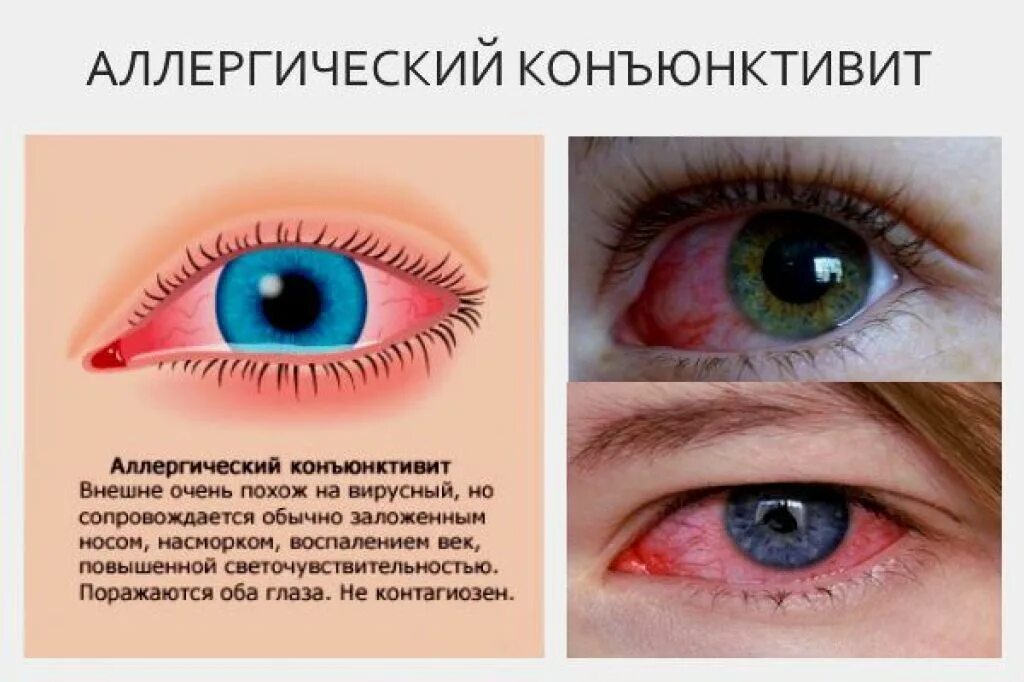 Аллергия конъюнктивит капли для глаз. Конъюнктивит бактериальный вирусный аллергический. Причины возникновения конъюнктивита. Вирусный и бактериальный конъюнктивит. Конъюнктивит воспаление.