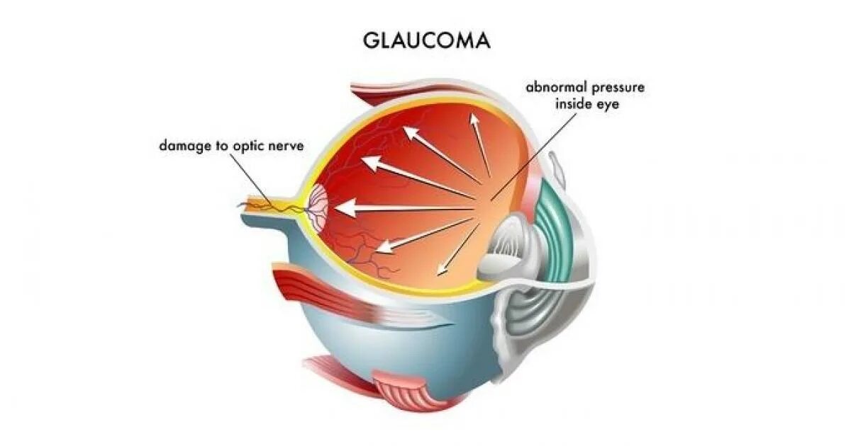 Повышение давления в глазу