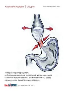 Недостаточность кардии 2