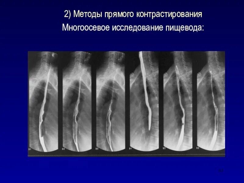 Как подготовиться к рентгену пищевода. Контрастирование пищевода рентген. рентген пищевода (эзофагография). фазы контрастирования пищевода рентген.