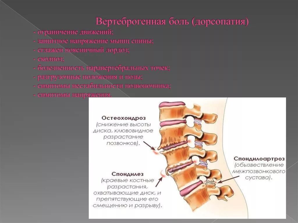 Вертеброгенная дорсалгия. Дорсопатия пояснично-грудного отдела. Дорсопатии поясничного отдела позвоночника. Дорсопатия позвоночника остеохондроз. Дорсопатии шейного отдела позвоночника.