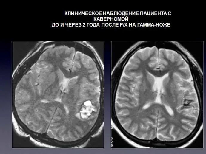 Ангиома головного мозга мрт. Ангиома правой височной доли. Ангиома правой височной доли. Кавернозная ангиома головного мозга мрт. Кавернома, ангиома головного.