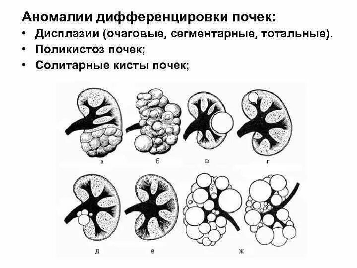 Медуллярная губчатая почка. Поликистозная дисплазия. Дисплазия почки презентация. Кистозная дисплазия почек. Дисплазия почки презентация.