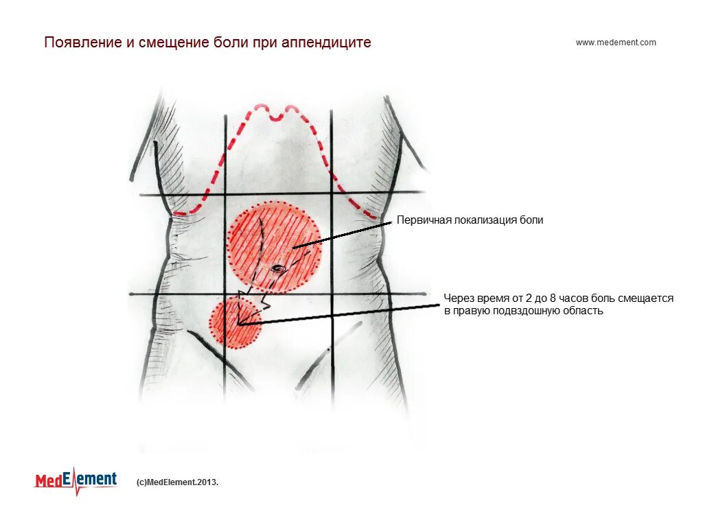 Локализация боли при остром аппендиците. Острый аппендицит иррадиация боли. Острый аппендицит локализация боли. Локализация боли при аппендиците. Зона боли при аппендиците.