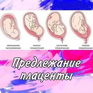 Плацента по передней стенке 20