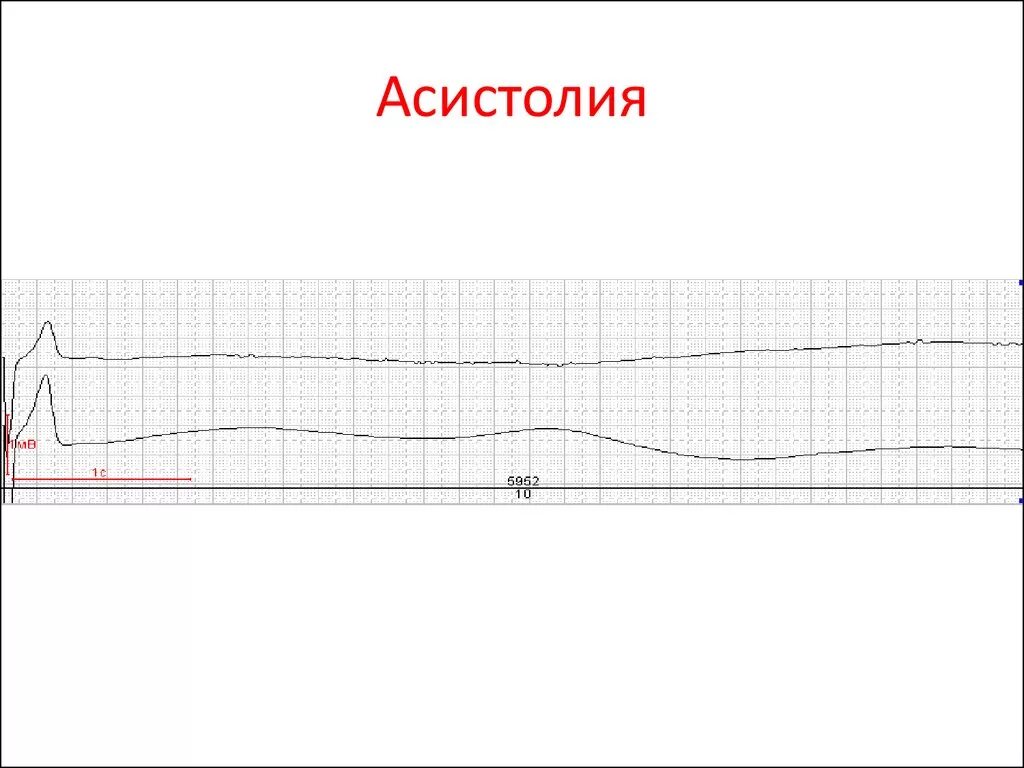 Асистолия на ЭКГ. Асистолия желудочков на ЭКГ. ЭКГ при асистолии. Асистолия рисунок.