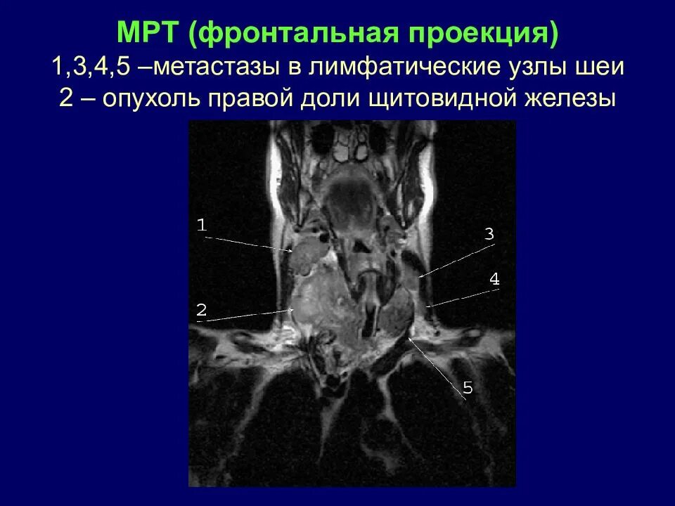 Кт мрт щитовидной железы. Лимфатические узлы мягких тканей шеи кт. Щитовидная железа мрт анатомия. Метастазы в лимфоузлы шеи мрт.