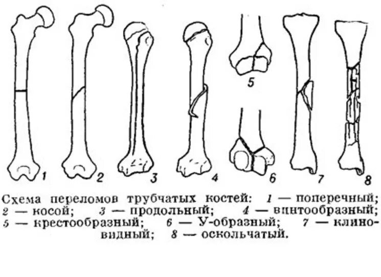Перелом кости может быть каким. Типы переломов по линии излома. Виды переломов трубчатых костей. Схема переломов трубчатых костей. Классификация перелома тручатых костей.