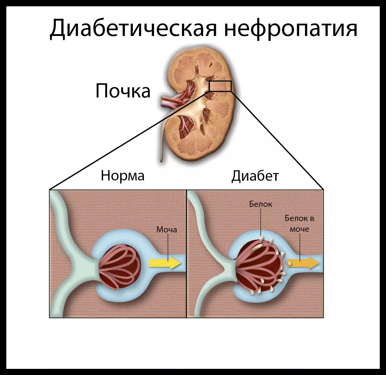 Диабет белок в моче. Диабет белок в моче. При сахарном диабете в анализе мочи отмечается. Диабет белок в моче. Моча диабетика.