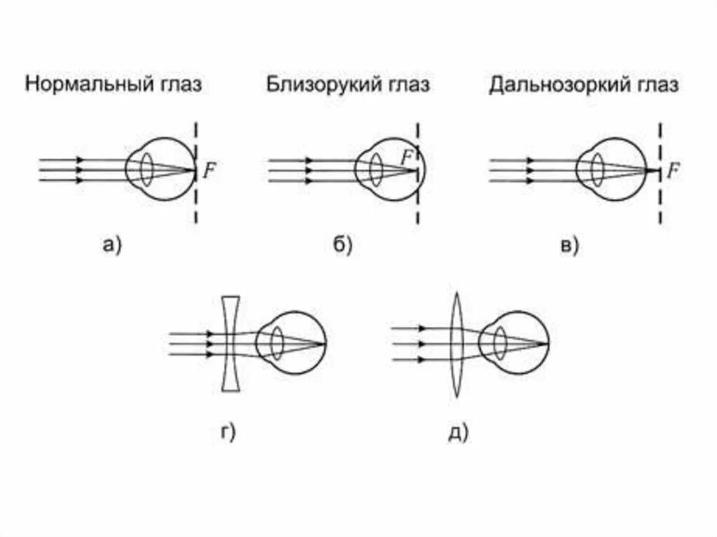 Схема рефракции в близоруком глазу. Схема преломления лучей при нормальной рефракции. Схемы рефракции при нормальном зрении при миопии при гиперметропии. Нормальный глаз дальнозоркий и близорукий схема. Нормальный глаз схема