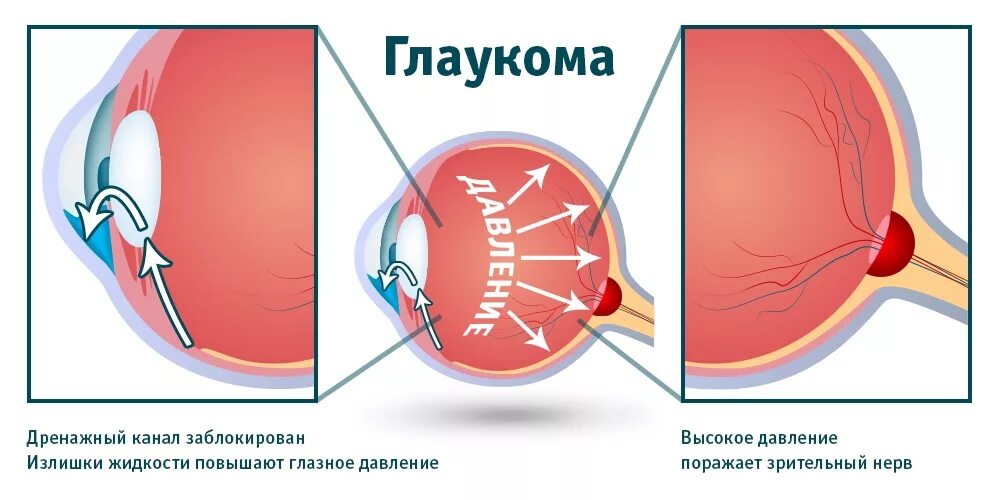 Открытоугол ная глаукома. Внутриглазное давление глаукома. Симптомы открытоугольной глаукомы.