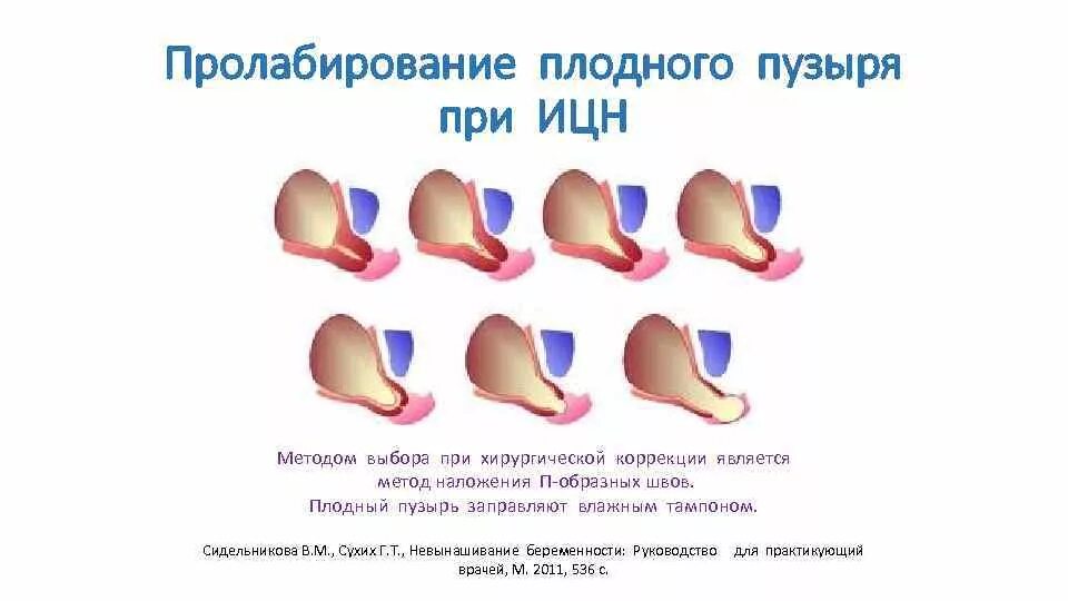 Пролабирование плодного пузыря. ИЦН С пролабированием плодного пузыря. Пролабирование плодного пузыря при ИЦН. Пролабирование пузыря при беременности. Швы при ицн