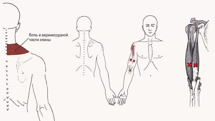 Точки болезненности. Триггерные точки анатомические поезда. Триггерные точки боль мышцы спины. Триггерные точки на спине схема. Триггерные точки на спине.