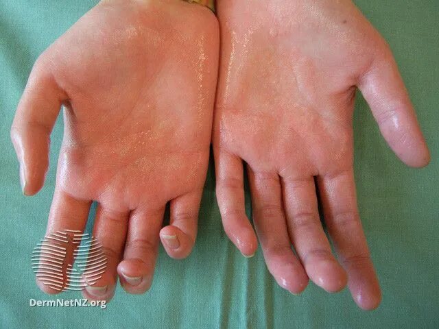 Псевдотуберкулез - признаки, причины, симптомы, лечение и профилактика - iDoctor