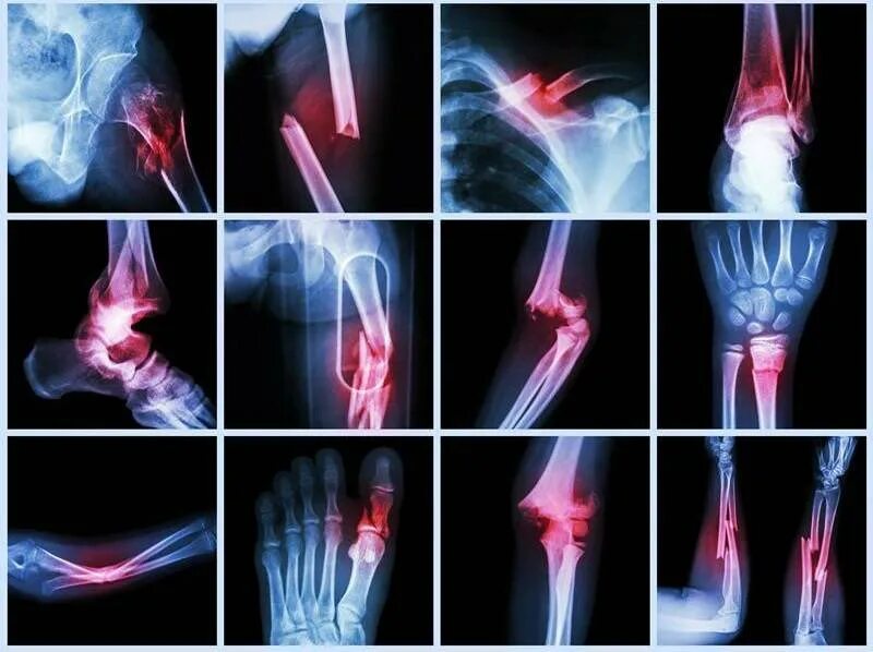 Рентгенограмма перелом кости. Травматология кости переломы. Перелом (Fracture), 2007. Рентгеновские снимки переломов.