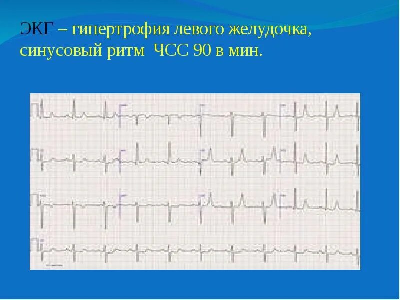 Синусовая тахикардия вертикальное. ЭКГ гипертрофия левого желудочка ритм синусовый отклонение ЭОС влево. ЭКГ тахикардия синусовый ритм ЧСС 90. ЭКГ ритм синусовый отклонение ЭОС. Синусовая тахикардия на ЭКГ.