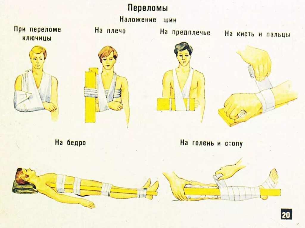 Транспортная иммобилизация при переломах костей. Наложение шины схема. Иммобилизация при переломе бедренной кости. Нужно наложить шину. При переломе конечности, шину накладывают:.