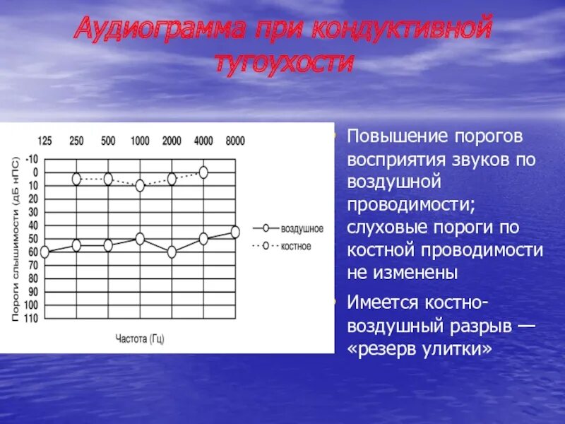 Слуховые пороги. Аудиограмма слуха кондуктивная тугоухость. Кондуктивная тугоухость 2 степени аудиограмма. Аудиограмма при кондуктивной тугоухости 1 степени. Тональная пороговая аудиограмма норма.