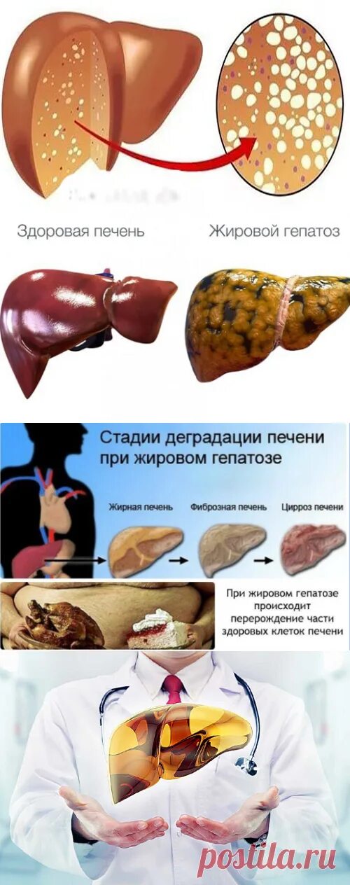 Полностью вылечить жировой гепатоз. Гепатоз ожирение печени. жировая дистрофия печени(жировой гепатоз). печень гепатоз жировой гепатоз. гепатоз печени симптомы.