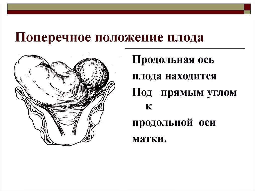 Положение плода поперечное головное. Продольное положение плода положения плода. Продольное головное положение плода при беременности. Головное предлежание плода при беременности продольное положение. Ребенок расположен справа