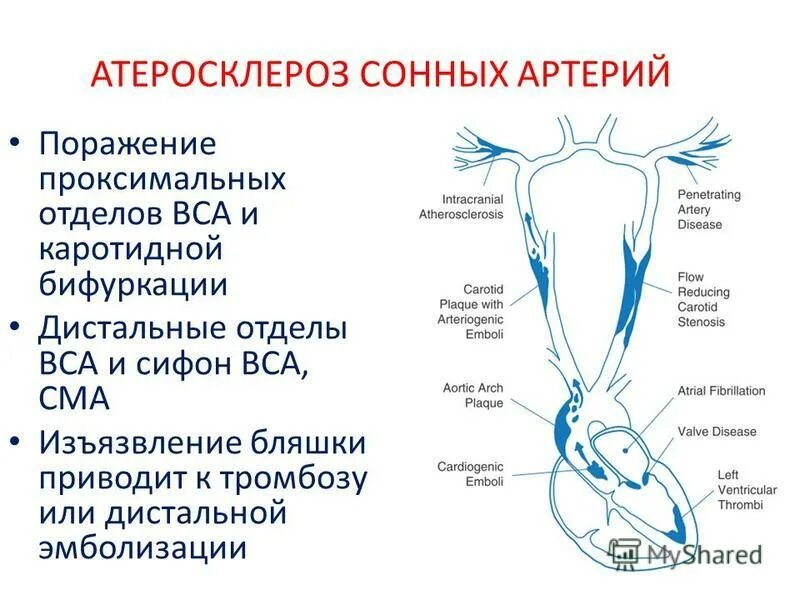 Стеноз устья вса. Атеросклероз бифуркации сонной артерии. Астросклез сооных артер. Стеноз внутренней сонной артерии. Каротидный атеростеноз это.