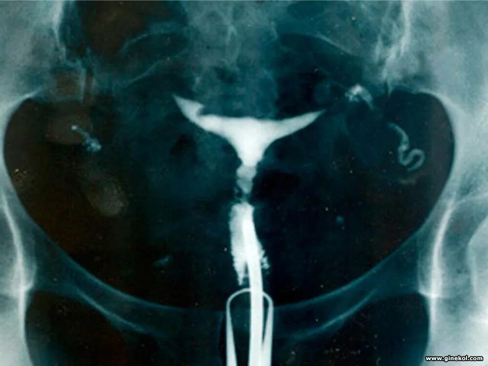 как смотрят маточные трубы. ультразвуковое исследование маточных труб на проходимость. мсг проходимость маточных труб рентген. как смотрят маточные трубы. гистеросальпингография что это такое в гинекологии.