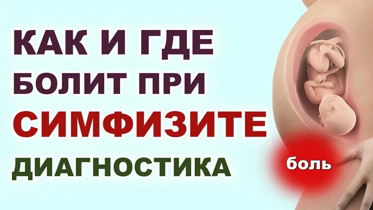 Симфизит при беременности симптомы 3. Где болит при симфизите. симптомы симфизита при беременности. симфизит симптомы в 3 триместре. где болит при симфизите у беременных.