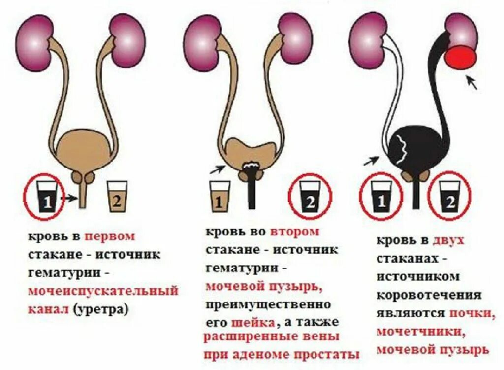 Трехстаканная проба мочи. Двухстаканная проба. Двухстаканная проба при гематурии. Моча 3-х стаканная проба. Двухстаканная и трехстаканная проба мочи.