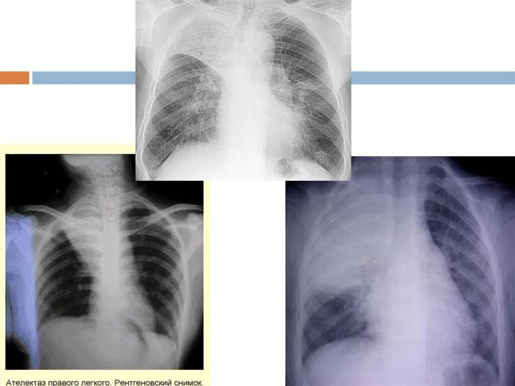 Признаки ателектаза легкого. Рентгенограмма Тотальный ателектаз. Рентген тотальное затемнение легкого. Ателектаз легкого рентген. Компрессионный ателектаз легкого рентген.