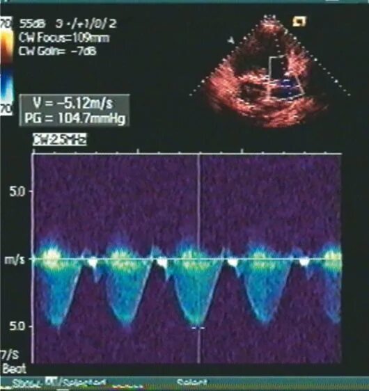 Аортальный клапан раскрытие створок на эхокг. Фон голубой градиент. Стеноз клапана легочной артерии. Перфузионно диффузионное отношение. Легочный градиент.