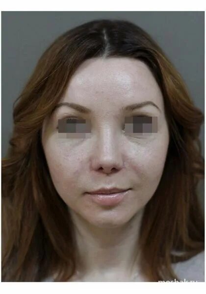 колумелла ринопластика. мошак пластический хирург ринопластика. пластическая операция на нос до и после. мошак сергей васильевич. романчук алексей леонидович владивосток хирург.