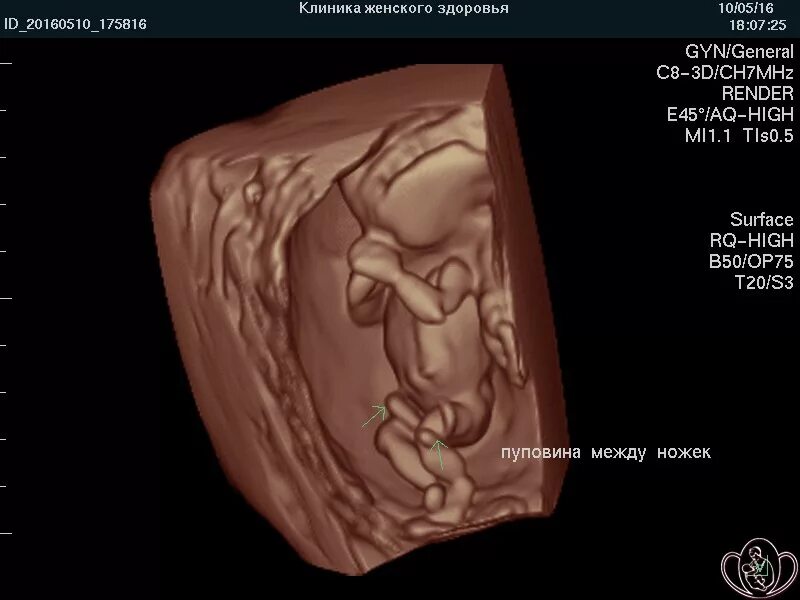 Плод на 16 неделе беременности УЗИ. УЗИ 15-16 недель беременности. УЗИ 16 недель беременности. Плод 16 недель беременности УЗИ плода. 16 неделя 2023