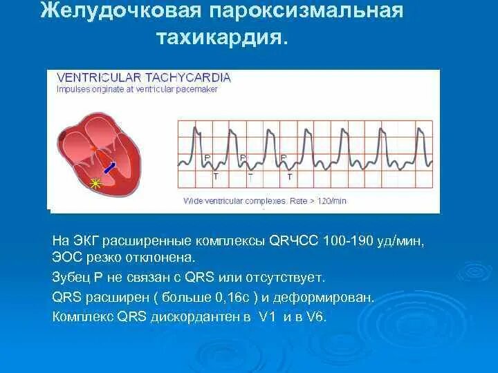 Какой ритм при пароксизмальной тахикардии. Экг при желудочковой пароксизмальной тахикардии. характеристика желудочковой тахикардии.