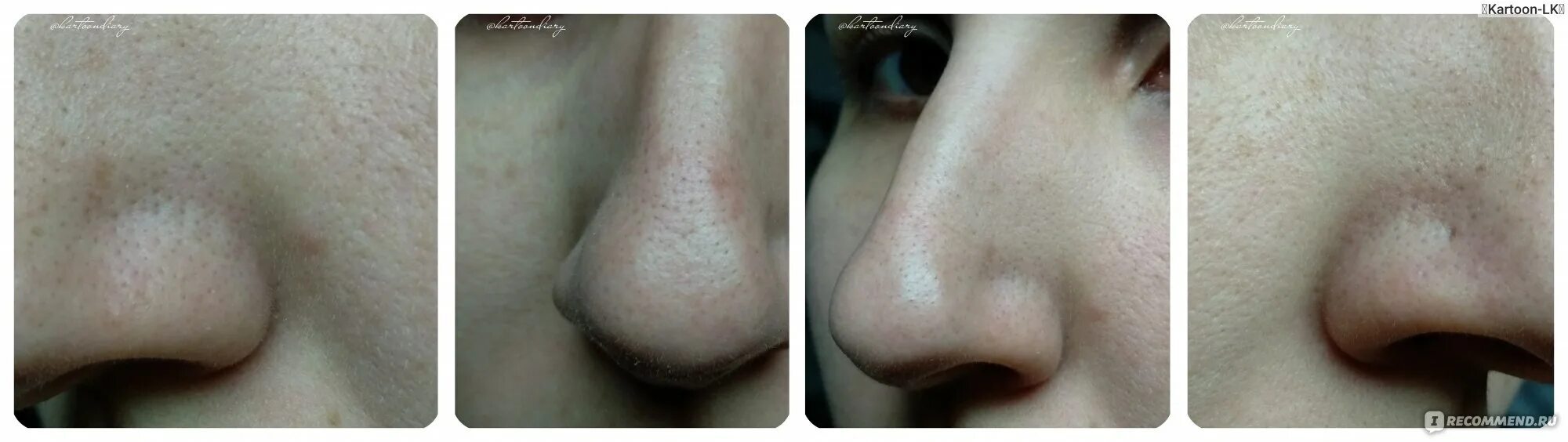 Черная против черных точек отзывы. Ciracle Pore Control Blackhead off Sheet. Салфетки сиракл от черных точек до после. Салфетки от черных точек Ciracle до после. Полоски против черных точек сиракл.