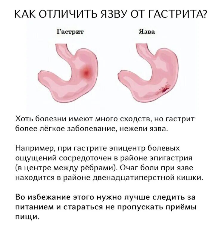 Как ощущается гастрит. Отличие язвы от гастрита. как отличить гастрит от язвы. отличия гастрита от язвенной болезни.