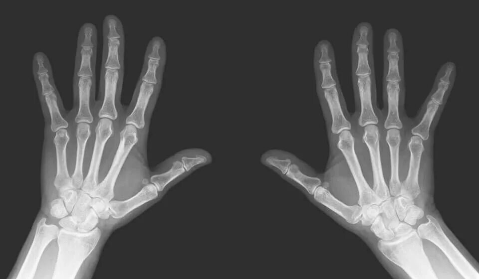 Рентгенограмма лучезапястного сустава. Рентген кисти правой руки норма. Кисть кости запястья рентген. Кости кисти рентген норма.