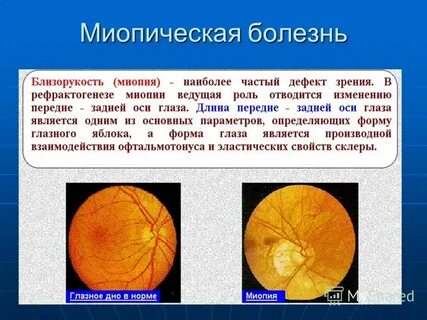 Тест с ответами миопическая макулярная дегенерация